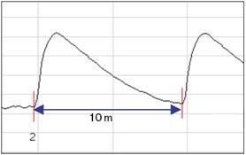 Figure 6. Attenuation dead zone